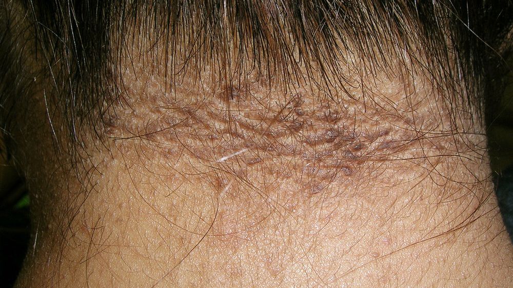 Jakie objawy daje cukrzyca?