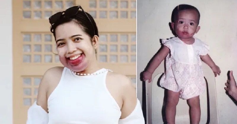 Późne leczenie zmieniło rysy twarzy Jenny