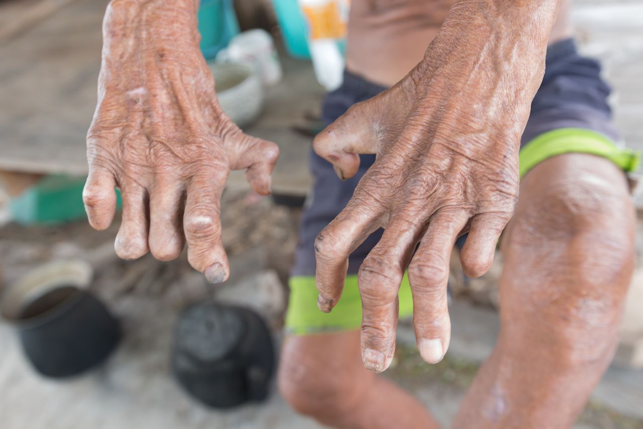 A resident of Texas suffered from a rash. It turned out that he has leprosy.