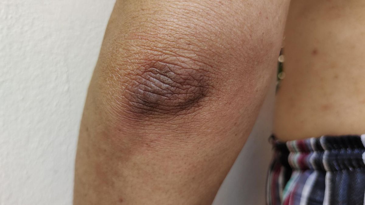 Rogowacenie ciemne może być objawem raka, cukrzycy czy chorób genetycznych