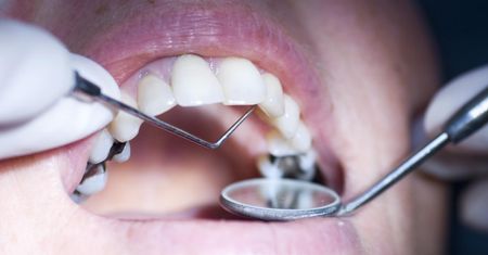 Amalgamat stomatologiczny a zdrowie. Toksyczny metal w zębach Polaków