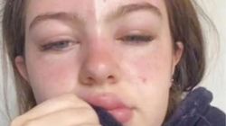 Myślała, że oparzenia słoneczne zamienią się w piękną opaleniznę. Efekt był tragiczny