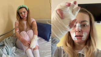 Tiktokerka, która PŁONĘŁA ŻYWCEM, przeszła kolejną operację. Pokazała, jak obecnie wygląda: "Kolejny krok do normalności" (FOTO)