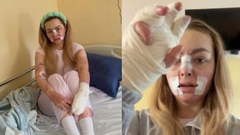 Tiktokerka, która PŁONĘŁA ŻYWCEM, przeszła kolejną operację. Pokazała, jak obecnie wygląda: "Kolejny krok do normalności" (FOTO)