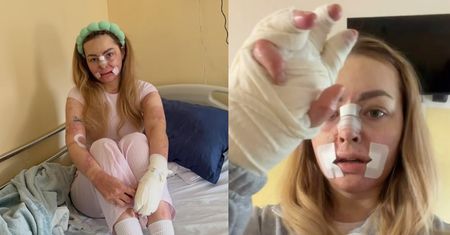 Tiktokerka, która PŁONĘŁA ŻYWCEM, przeszła kolejną operację. Pokazała, jak obecnie wygląda: "Kolejny krok do normalności" (FOTO)