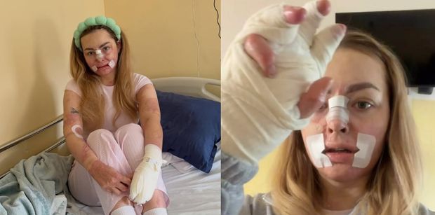 Tiktokerka, która PŁONĘŁA ŻYWCEM, przeszła kolejną operację. Pokazała, jak obecnie wygląda: "Kolejny krok do normalności" (FOTO)