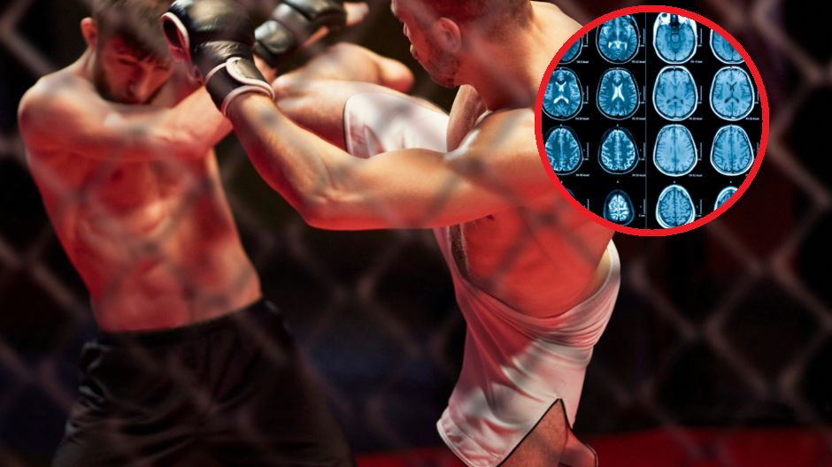 Przewlekła encefalopatia pourazowa nie jest tylko problemem bokserów