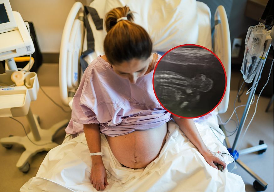 Córeczka Wiktorii urodziła się z ogromnym guzem - miał 20 cm i ważył 770 gramów