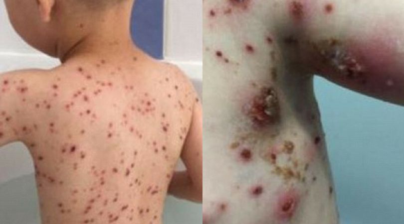 Skutki podawanaia ibuprofenu w trakcie ospy