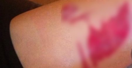 Pokazała rany po nieudanym zabiegu kosmetycznym. Płakała z bólu