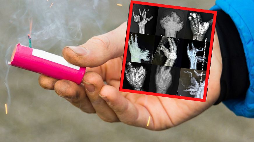 Nieostrożna zabawa z petardami prowadzi do poważnych wypadków