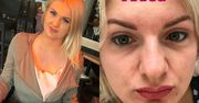 Uczestniczka programu "Projekt Lady" pokazała zdjęcie po operacji nosa: "Młodziej z nowym noskiem?"
