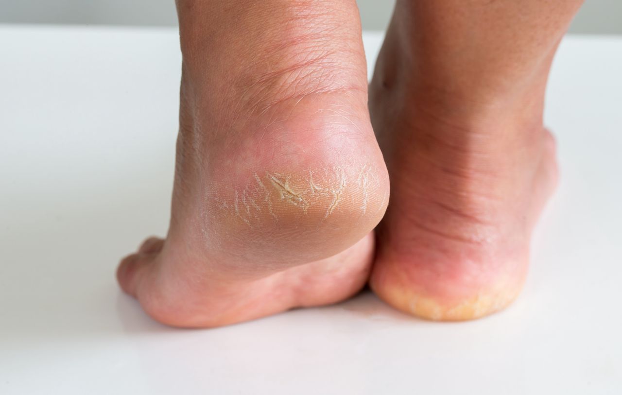 Affordable ointment found to be effective for yellow, cracked heels