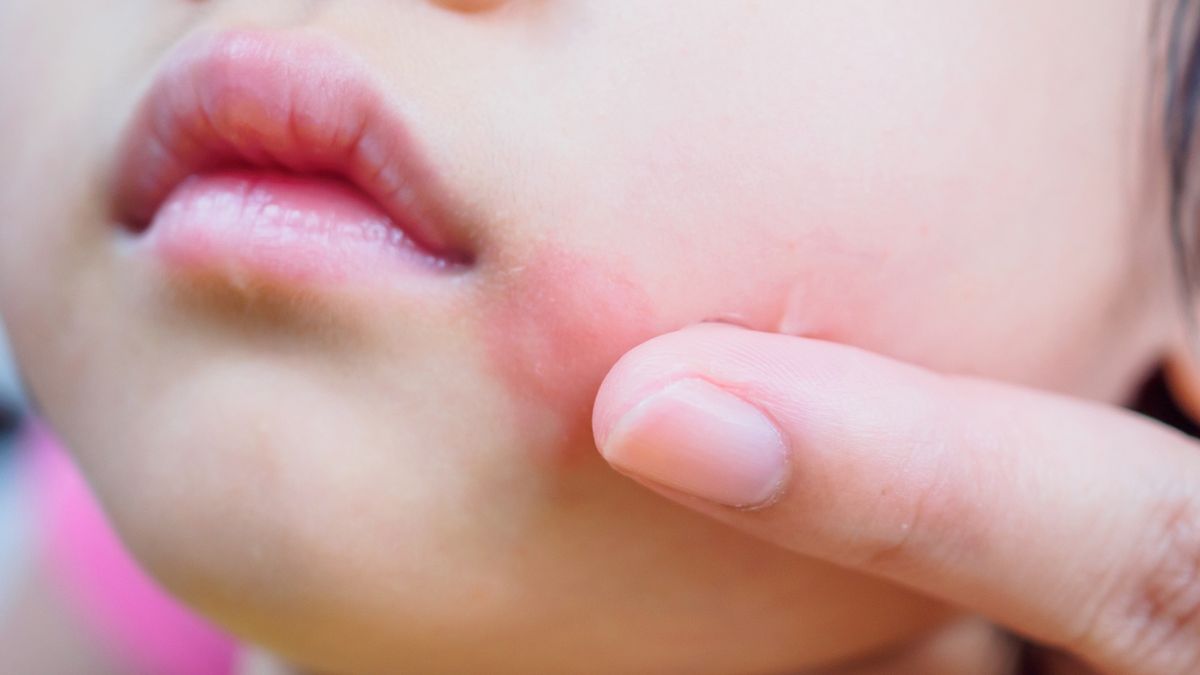 Liszaj na twarzy ma postać grudkowatych zmian