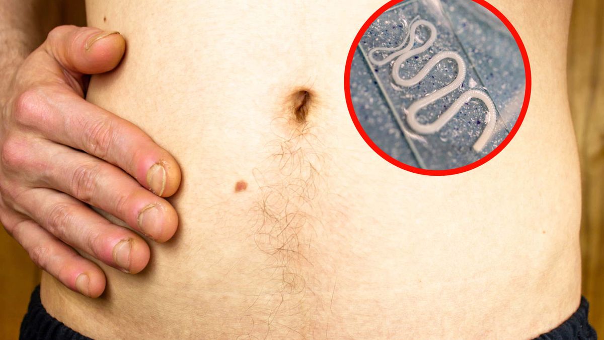 Te objawy mogą sugerować, że masz tasiemca. Pasożyt może doprowadzić do groźnej choroby