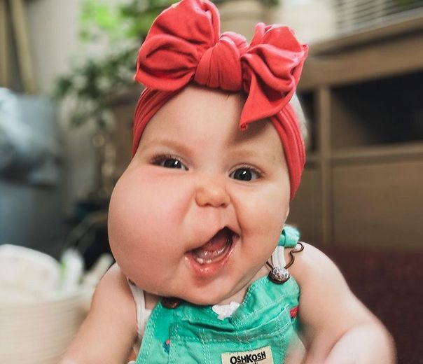 15-miesięczna Mollie urodziła się z tłuszczakiem