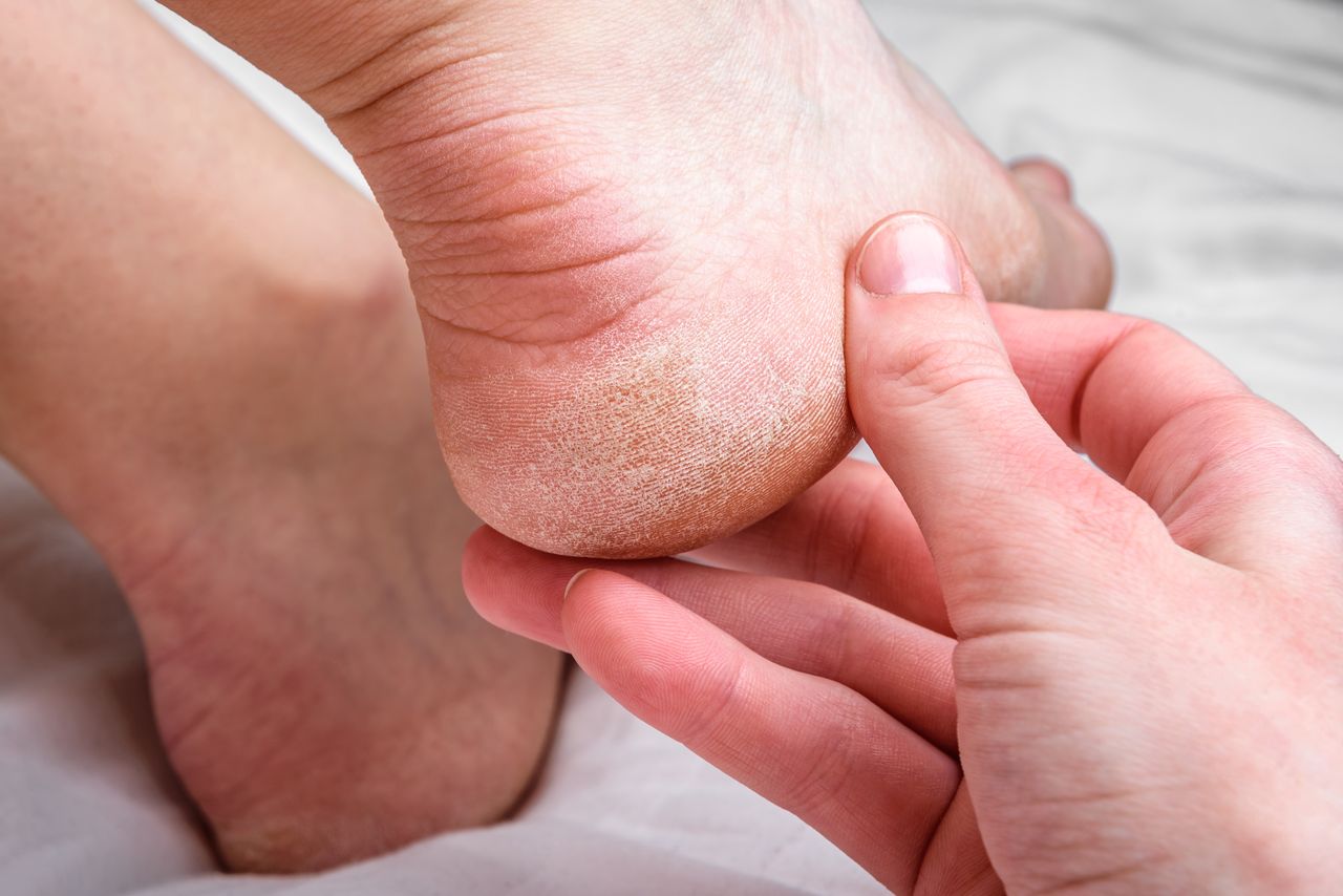 Działa jak plaster na popękane pięty. W aptece kosztuje grosze