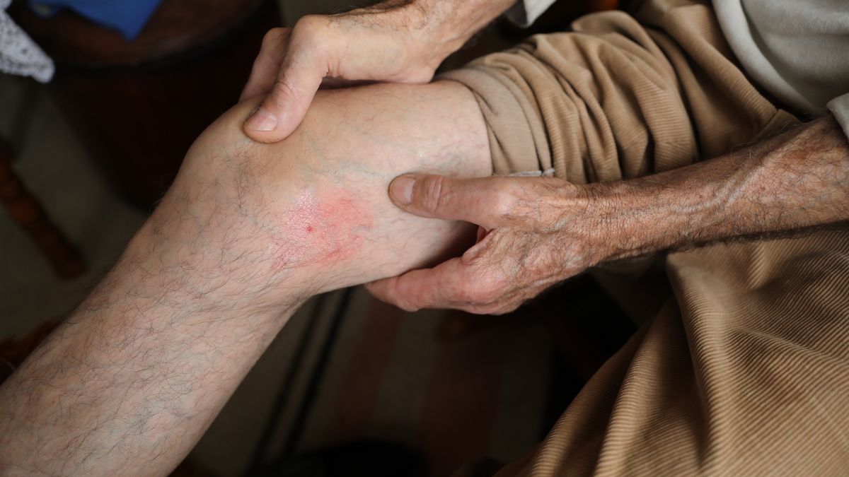 Part of a leg (thigh) of the man with varicose veins and capillaries before  medical treatmentPart of a leg (thigh) of the man with varicose veins and capillaries before  medical treatmentGabrijelagal