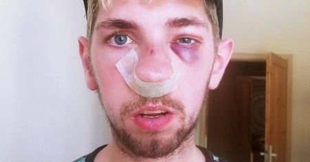 Pobili go w biały dzień na plaży przy Rusałce. Złamanie czaszki