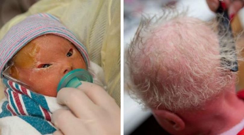 Płód arlekin - ta dziewczynka urodziła się z bardzo rzadką chorobą genetyczną