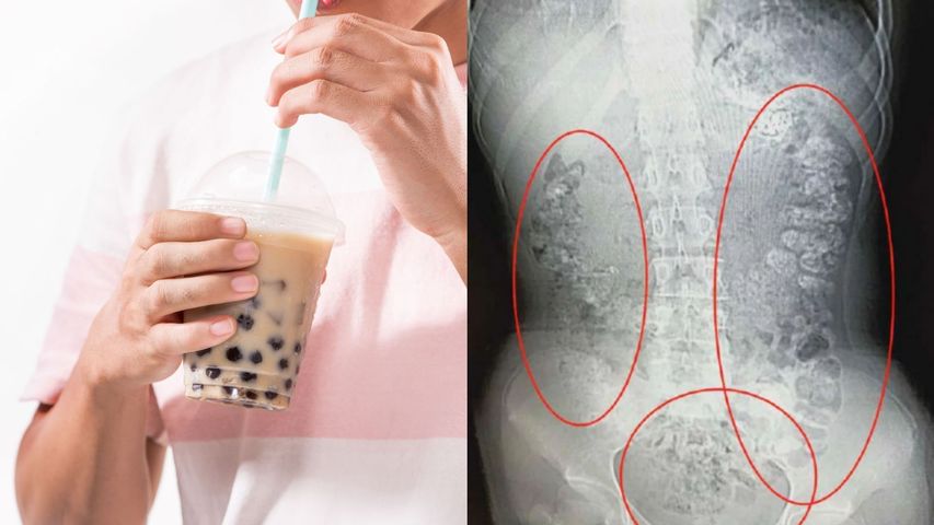Nastolatka zgłosiła się do lekarza z bólem brzucha. To skutek picia bubble tea