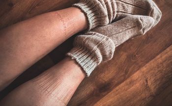 Masz takie ślady po skarpetkach? Chirurg naczyniowy tłumaczy