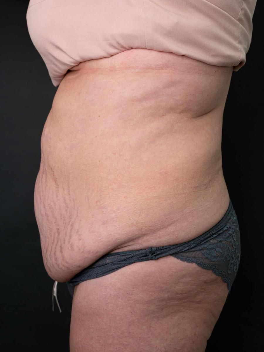 Brzuch pani Anety przed operacją