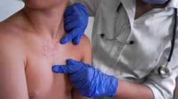 Grzyby mogą prowadzić do ciężkich zakażeń. "Rozwijają się po cichu, w cieniu innych chorób"