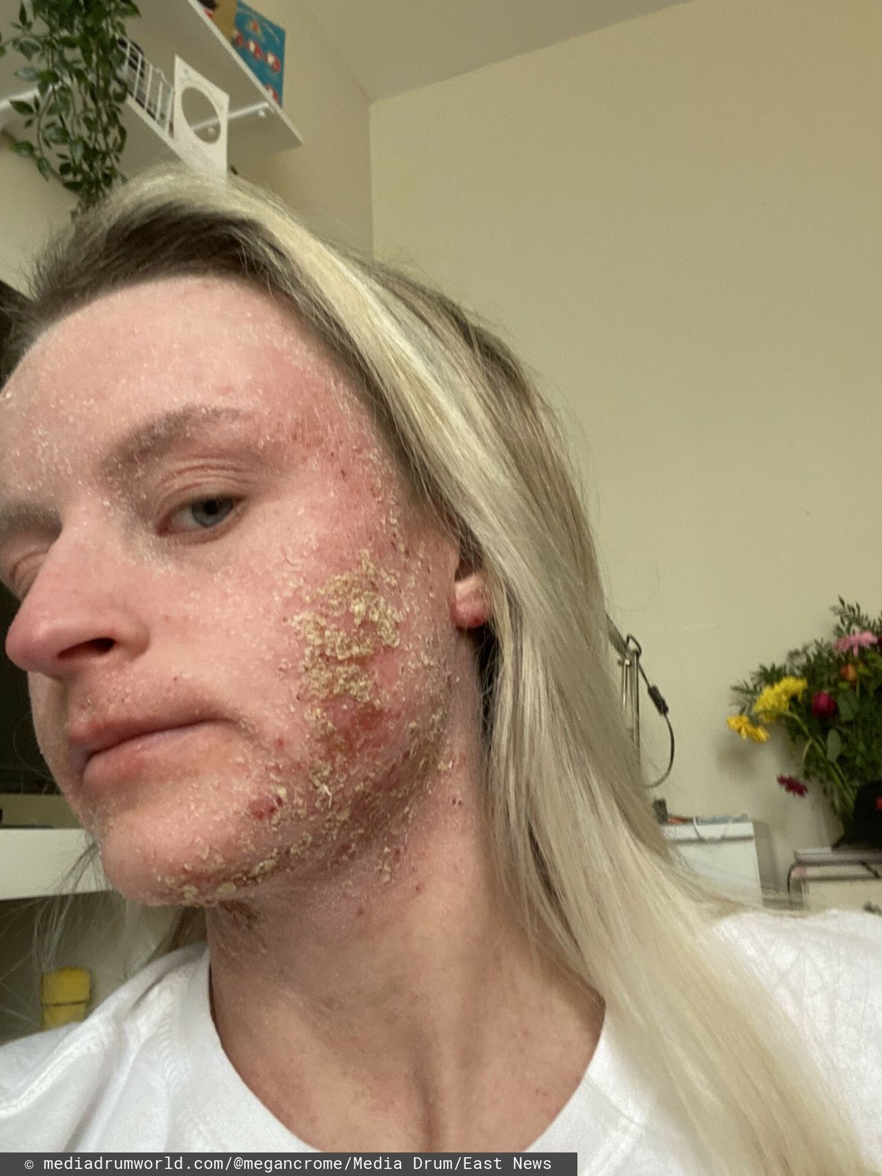 Choroba zaatakowała twarz Megan