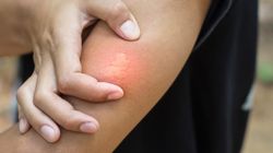 Pierwsza pomoc po użądleniach. "Nie czekamy na duszności czy omdlenia, bo wtedy może być już za późno na ratunek"