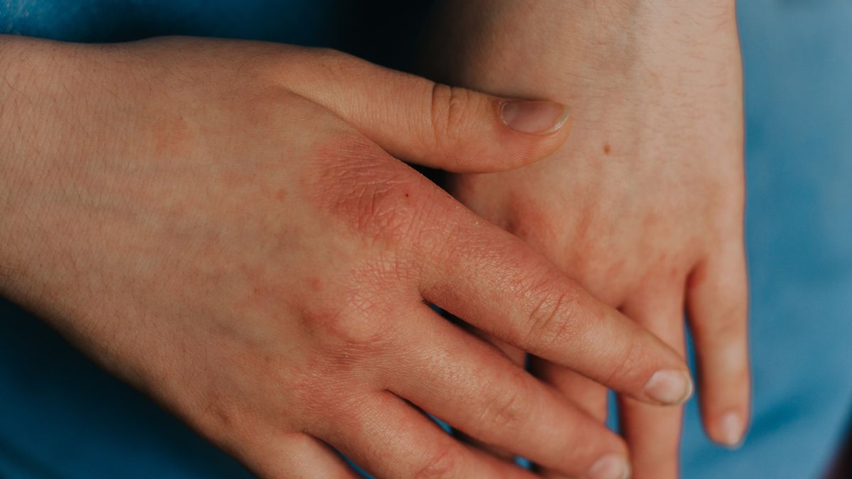 Świerzb norweski jest rzadką, najcięższą i bardzo zakaźną postacią świerzbu