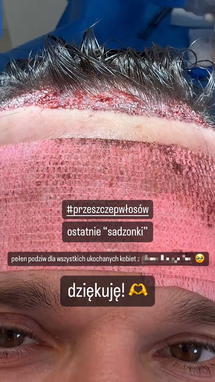 Qczaj zrelacjonował przeszczep włosów