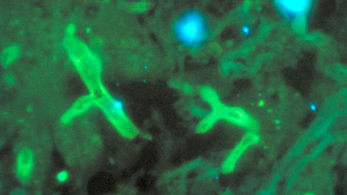 Ozdrowieńców z COVID-19 atakują infekcje grzybiczne