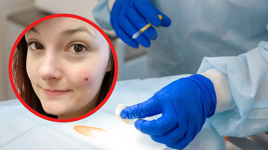 Uroczy pieprzyk okazał się śmiertelnie niebezpieczny 