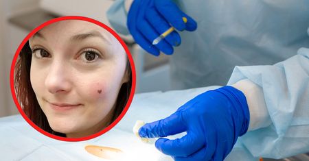 Miała na policzku pieprzyk w kształcie serca. Usłyszała druzgocącą diagnozę