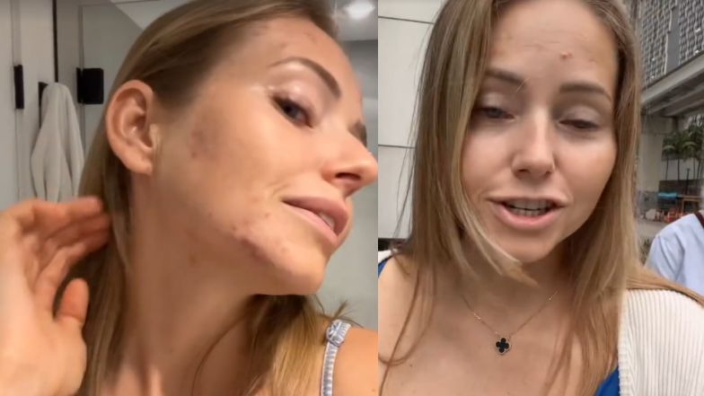 Agata Rubik żali się na trądzik