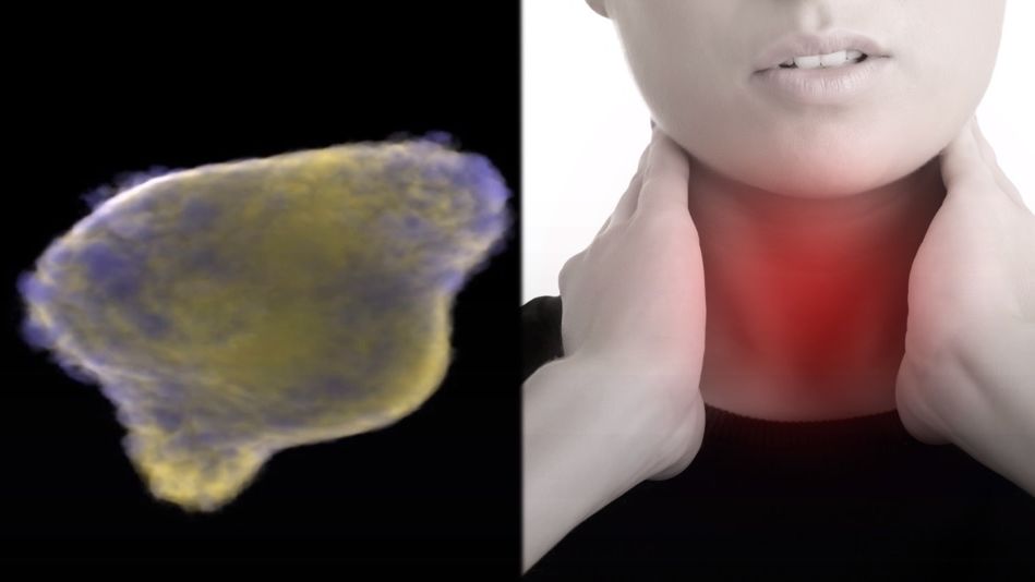 Rak przełyku długo nie daje objawów