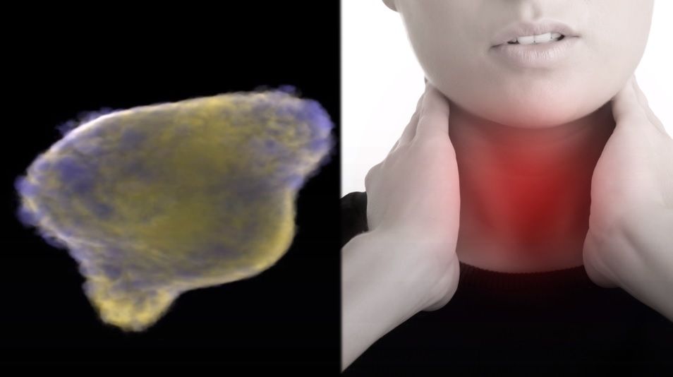 Objawy raka przełyku. Zobacz, czy znasz (WIDEO)