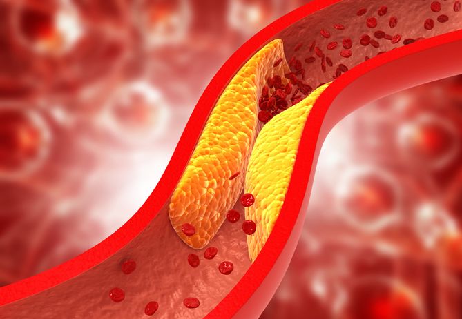 Hipercholesterolemia Ryzyko Związane Z Wysokim Poziomem Cholesterolu Jak Obniżyć Cholesterol 6460