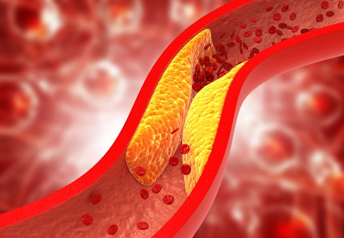 Hipercholesterolemia oznacza podwyższone stężenie cholesterolu LDL we krwi.