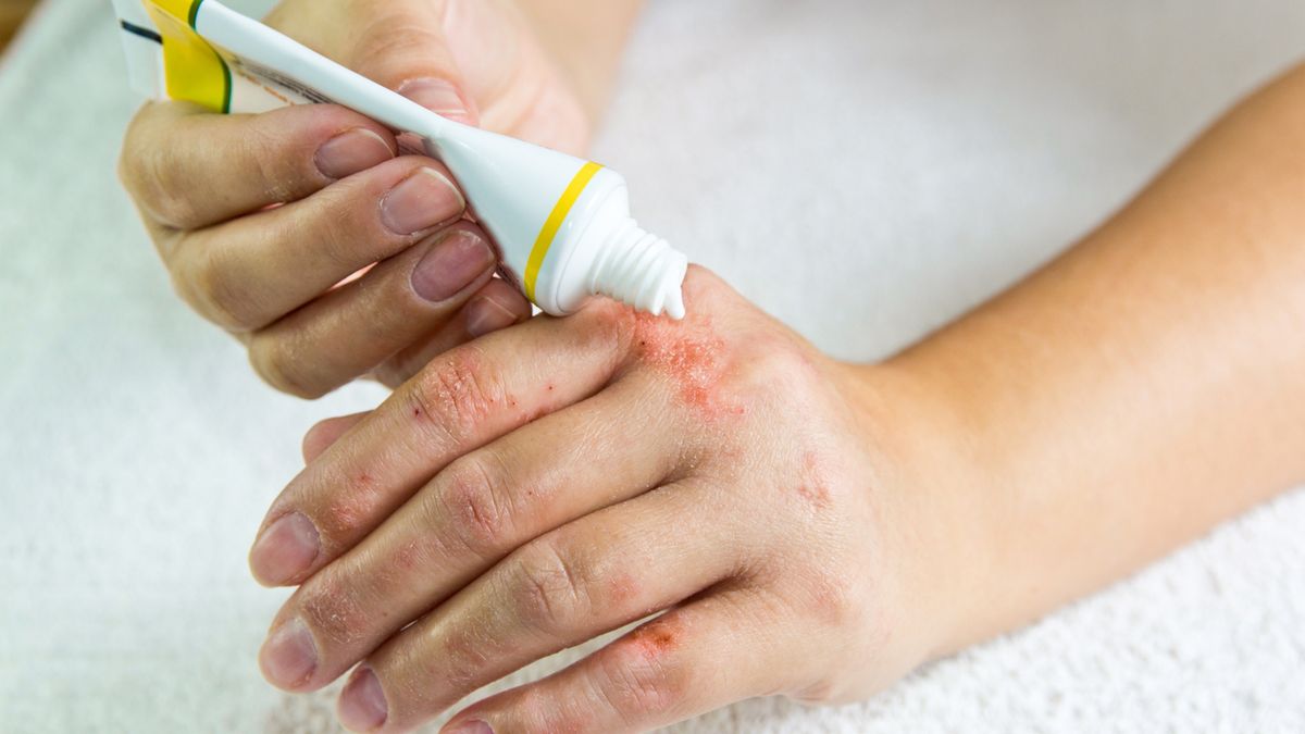 Nerwica skóry może objawiać się różnymi zmianami dermatologicznymi