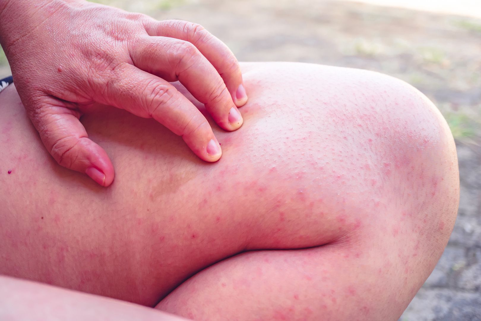 Human skin with red blisters, Close-up of human skin with varicella papules or papules due to certain viral infections., Measles
Human skin with red blisters, Close-up of human skin with varicella papules or papules due to certain viral infections., Measles
Singjai20