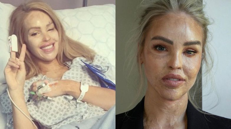 Katie Piper's journey after losing sight in an acid attack. Over 400 surgeries and her life now