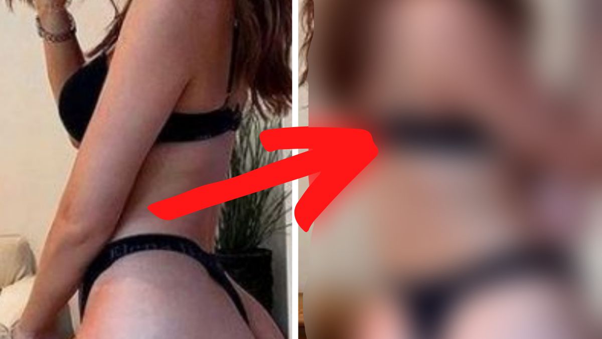 przed i po zdjecia cellulit gwiazda