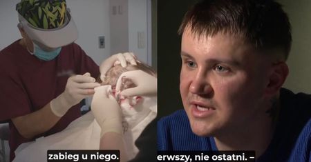 Poddali się przeszczepowi włosów w polecanej klinice. Czują się OSZPECENI. "Doszło do śmierci"