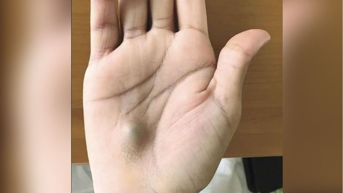 Guzek na ręce był objawem tętniaka