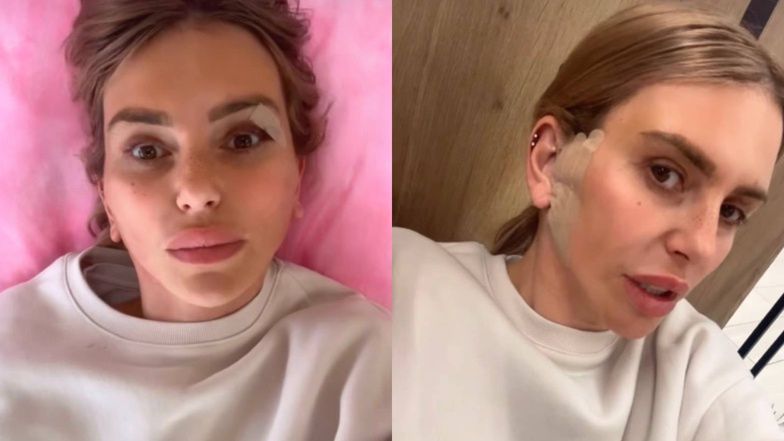 Monika Goździalska chwali się efektami liftingu brody