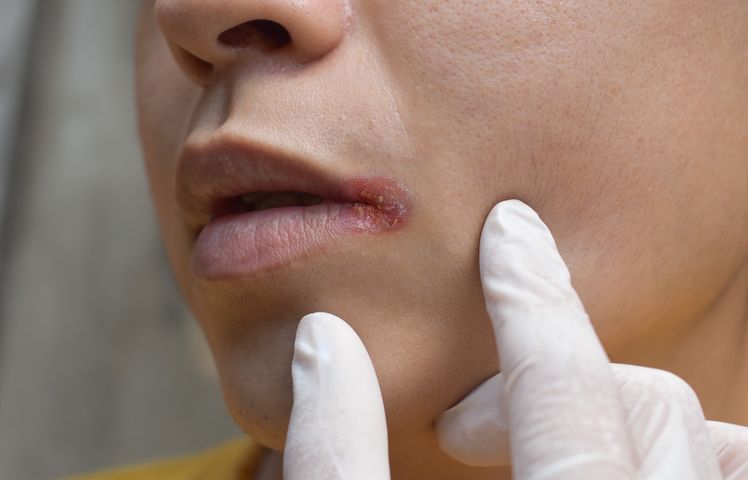 Grzybica jamy ustnej występuje u osób z obniżoną odpornością organizmu.