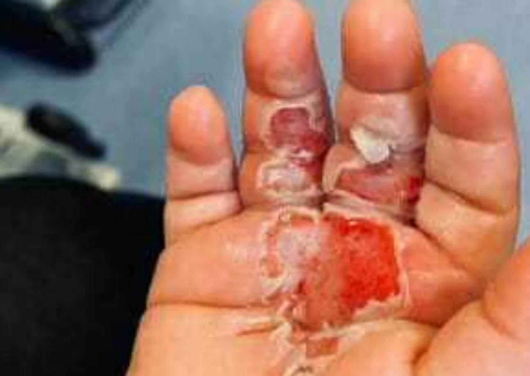 Odkurzacz wessał rękę dziecka. Chłopiec doznał oparzeń i wstrząsu toksycznego