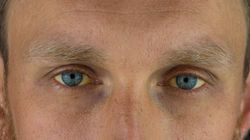 Nietypowe objawy chorej trzustki. Część widać na skórze